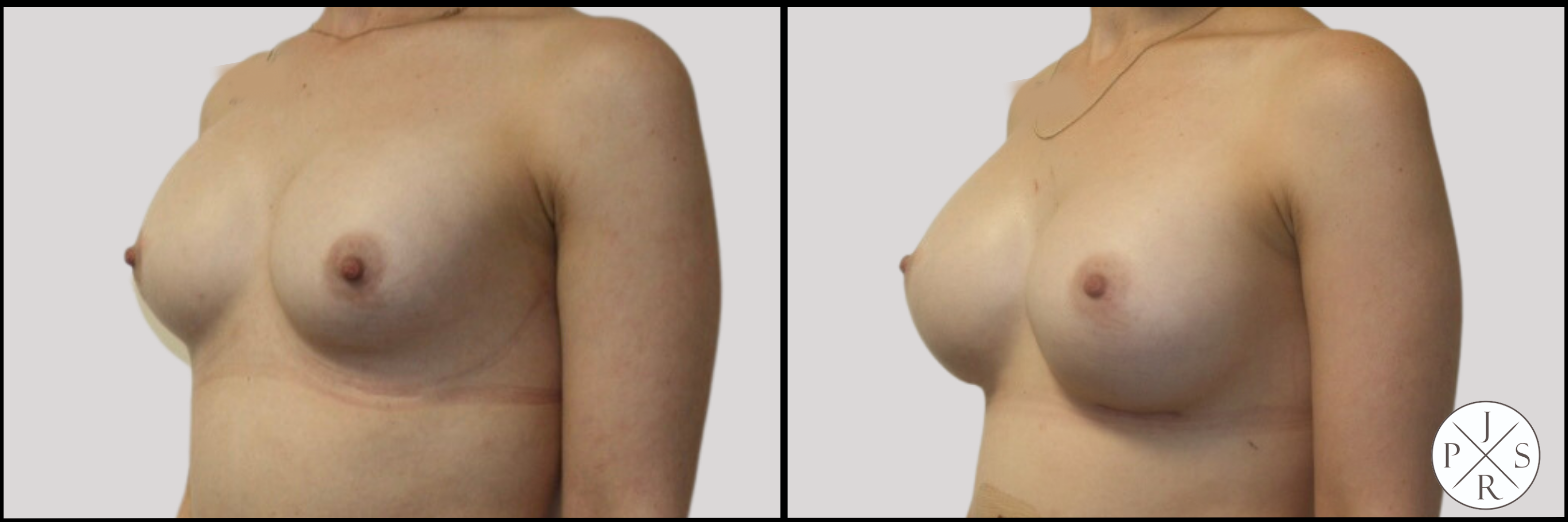 Breast Revision Before & After Image